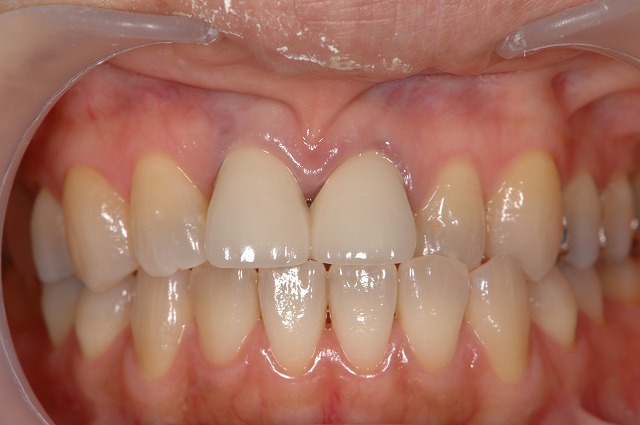 前歯がぐらつき歯肉が腫れる-1