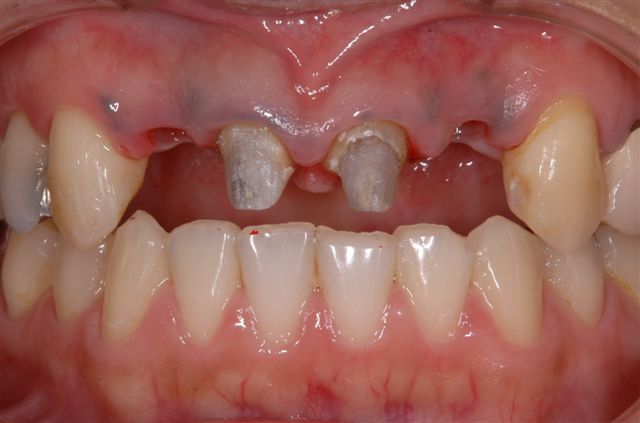 前歯のブリッジが破損-1