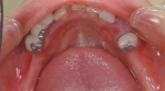 ５０代女性患者　若い頃から歯にコンプレックスを持ってる　噛めない-2