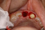 前歯がぐらつき歯肉が腫れる-2