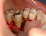 歯周病の骨再生療法-4