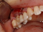 歯周病の骨再生療法-5