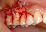 歯周病の骨再生療法-2