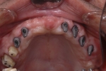 歯周病で歯がぐらぐらする-3