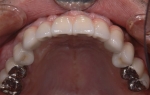 歯周病で歯がぐらぐらする-4