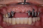 歯周病で歯がぐらぐらする-2