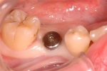 先天性の永久歯欠損-1