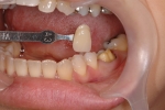 奥歯の審美治療-1