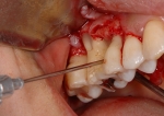 歯周病の骨再生療法-3
