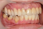 以前治療した歯の 歯肉の退縮が気になる -2